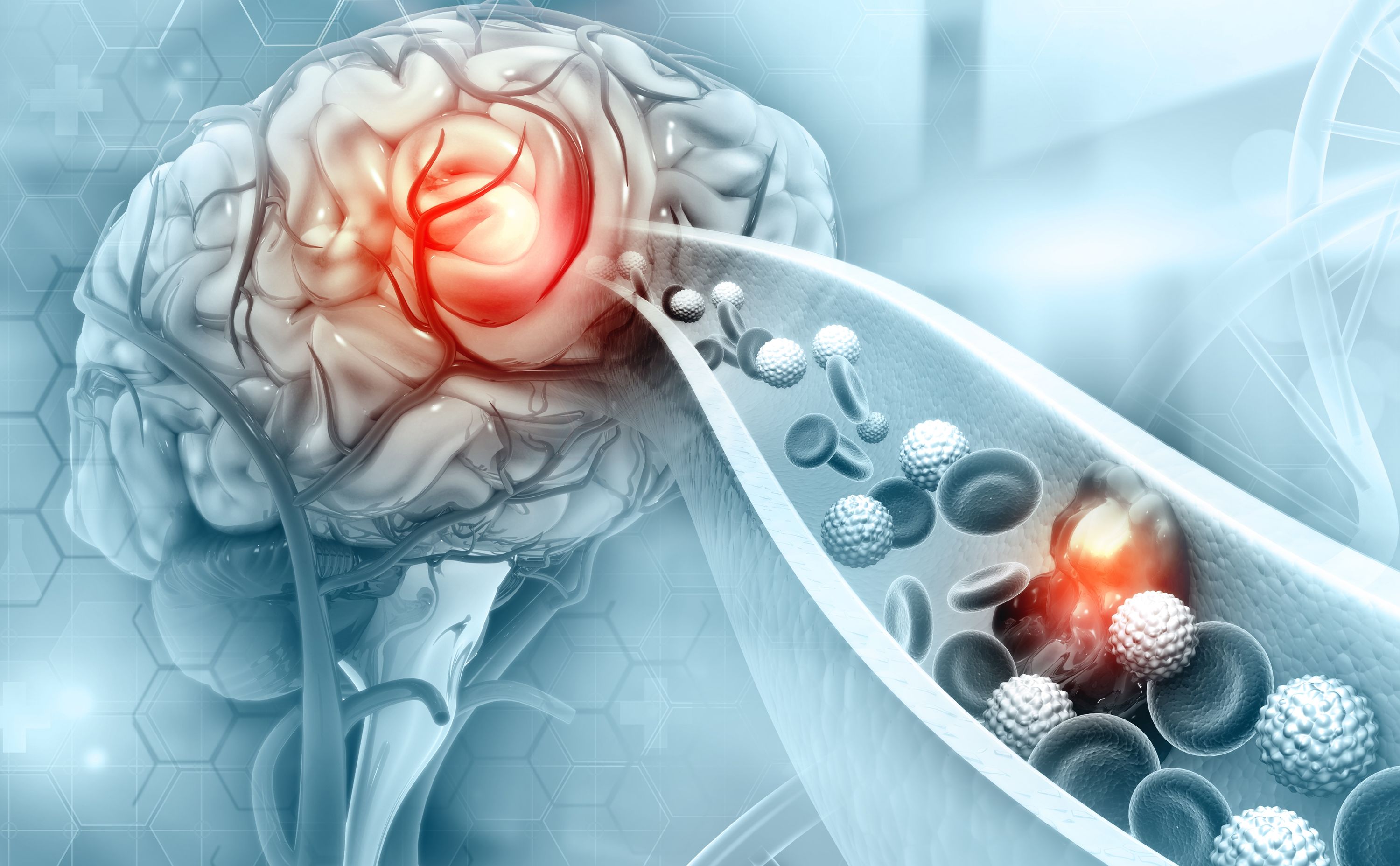 Udar: iniekcyjna terapia chroniąca mózg – przełom w nanomedycynie regeneracyjnej