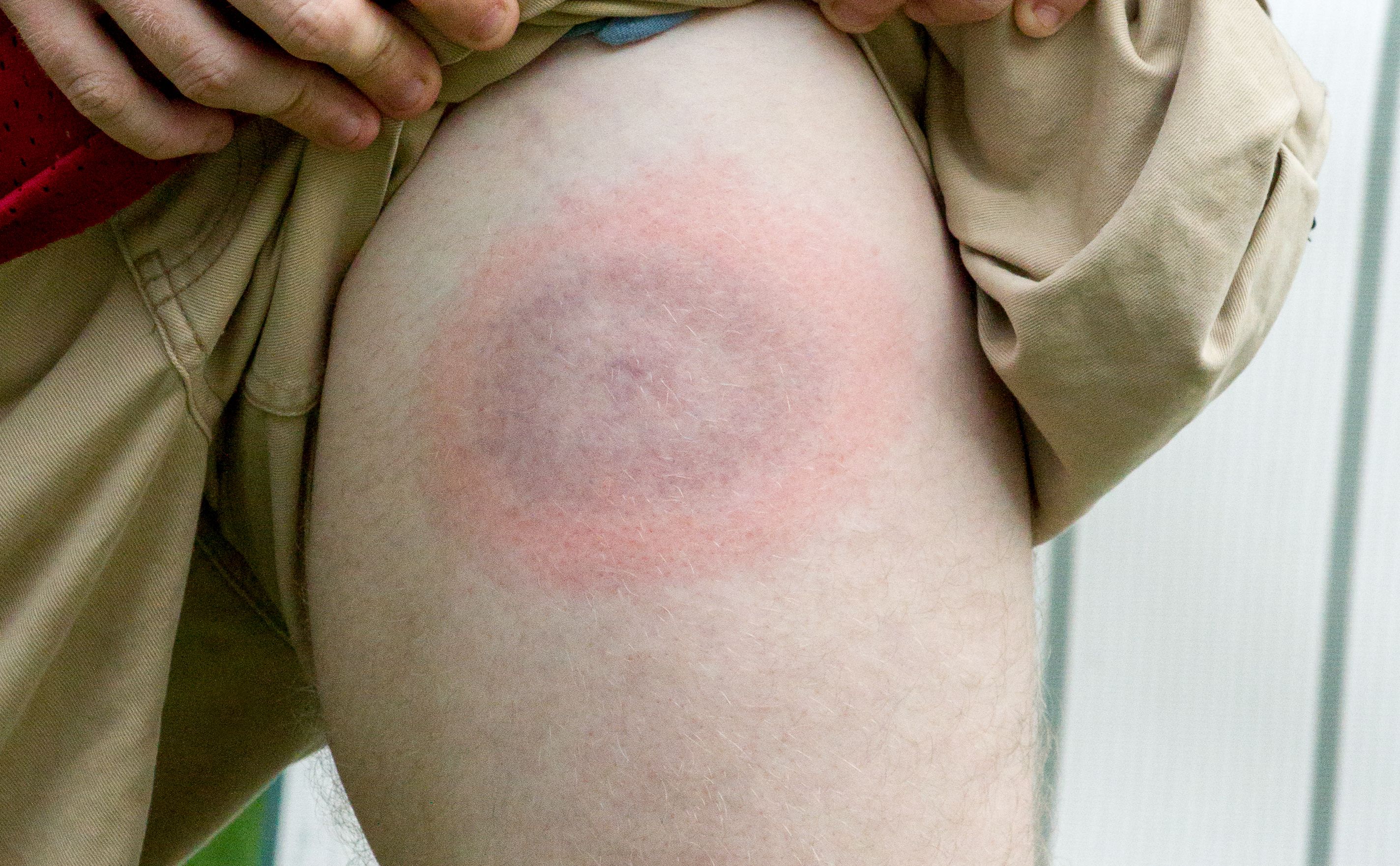 borelioza z Lyme choroby odkleszczowe kleszcze 2025 objawy boreliozy leczenie boreliozy rumień wędrujący antybiotyki borelioza jak usunąć kleszcza profilaktyka kleszczy sezon na kleszcze zdrowie poradnik zdrowotny