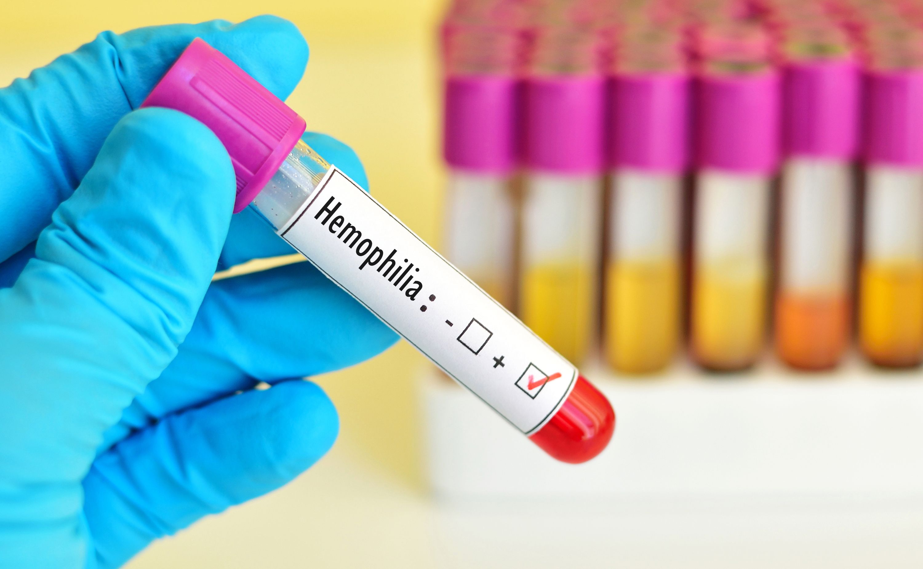 hemofilia zdrowie Ministerstwo Zdrowia leczenie refundacja terapie innowacyjne Hemlibra marstacymab koncizumab krew pacjenci leki