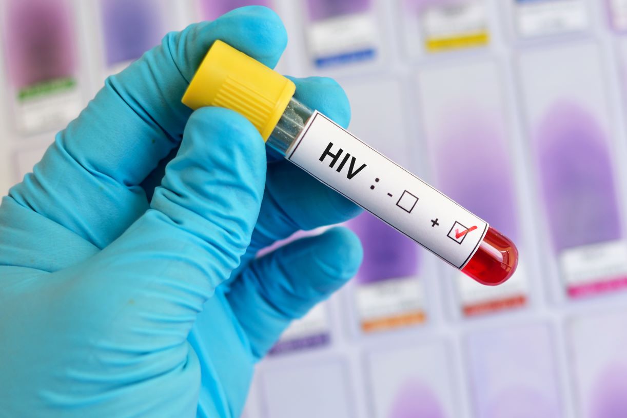 hiv test próbka dodatni pozytywny krew wirus aids