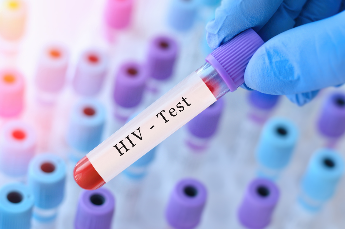 Test na HIV