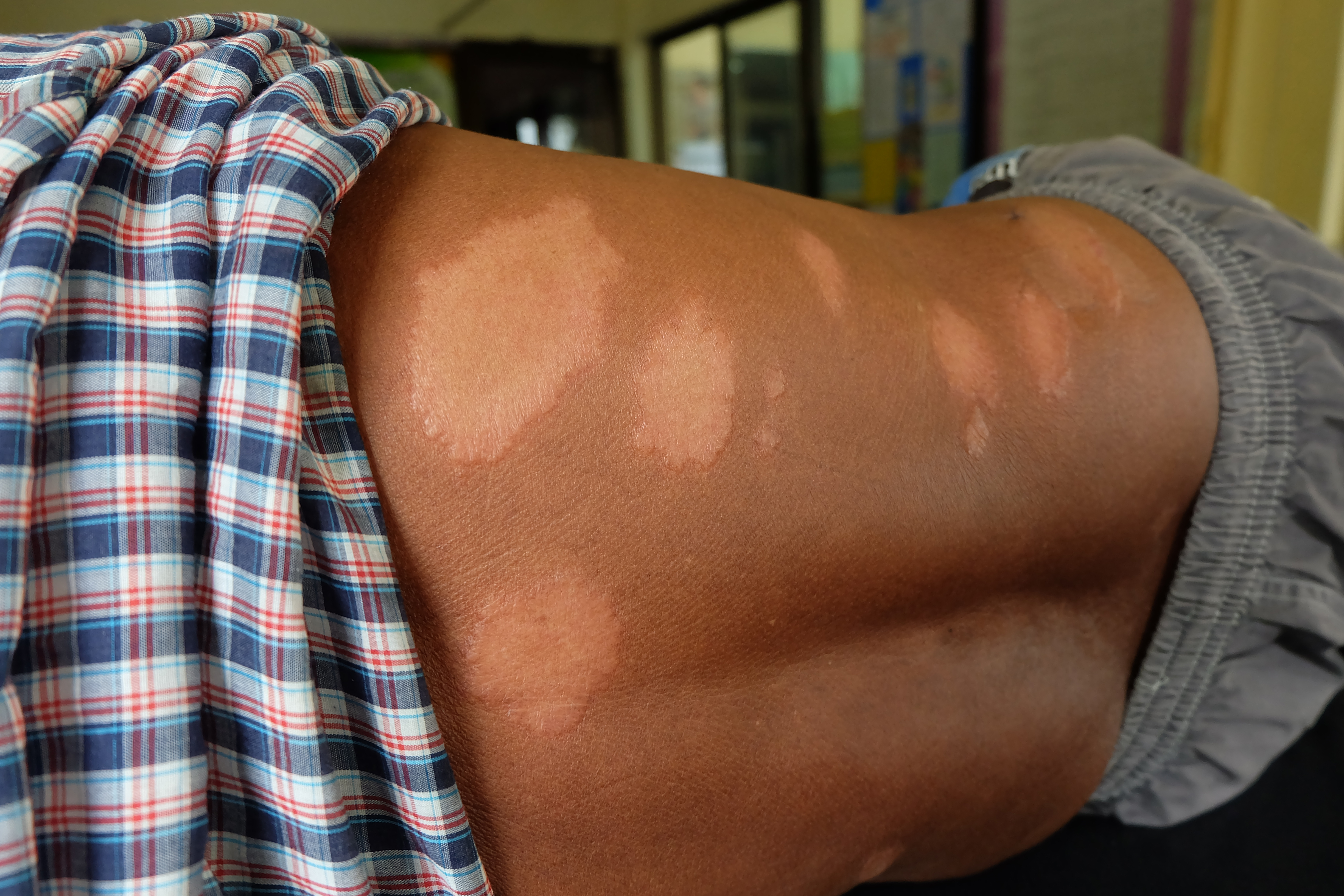 Trąd w Rumunii. Dwie osoby zakażone, dwie kolejne na obserwacji