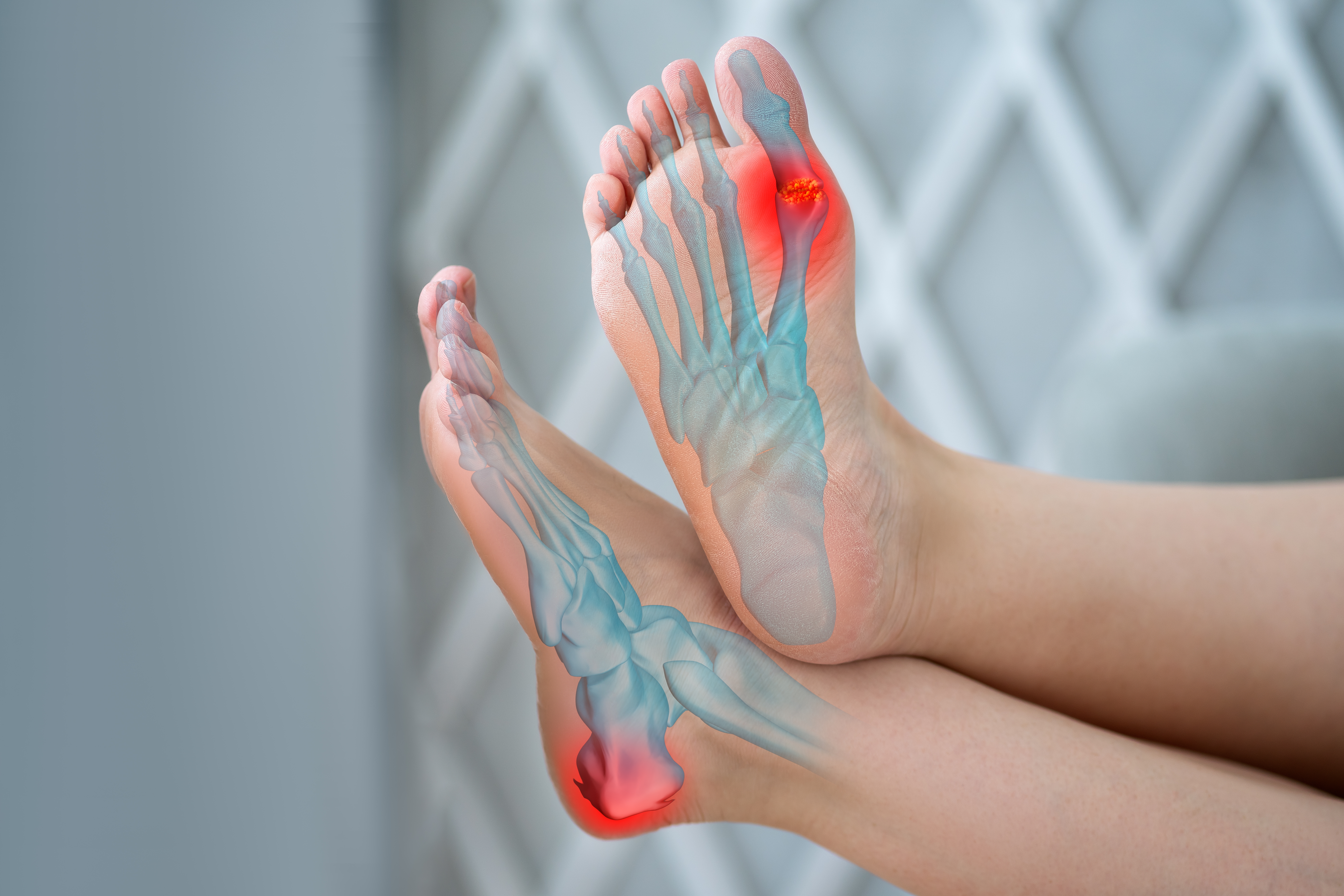 Dna moczanowa - objawy, przyczyny, rodzaje, leczenie, dieta